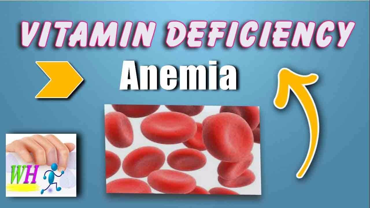 Anemia Fatigue Extreme Health Academy